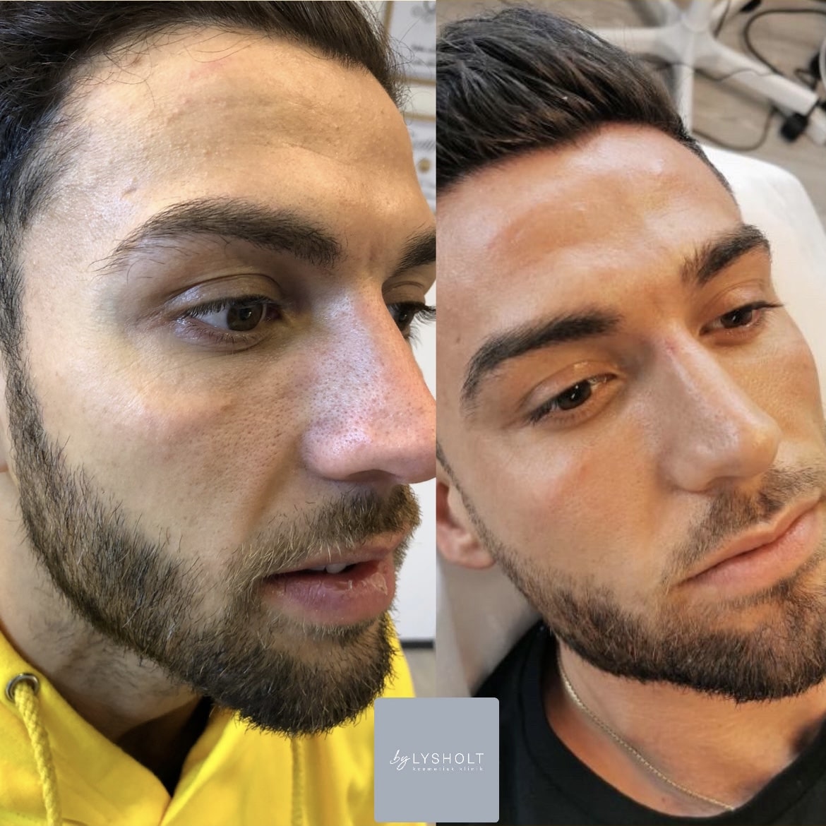 micro needling århus